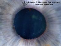 Pseudoexfoliation syndrome demonstrating the three identifiable zones on the anterior lens capsule. Note in the second picture (taken from a different patient) the white flaky material deposits on the pupillary margin